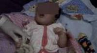 Malangnya, Bayi Tanpa Tempurung Kepala Lahir di Pekanbaru